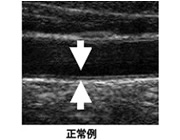 首：頚部エコー 正常例 写真