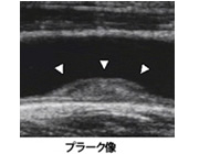 首：頚部エコー プラーク像 写真