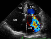 心エコー 写真02