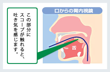口からの胃内視鏡図