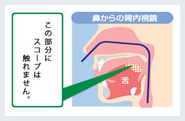 鼻からの胃内視鏡図