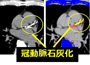 冠動脈CT検査 写真01